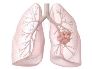 Рак лёгких
